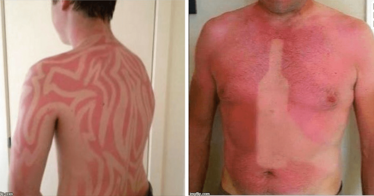 Diese 20 Sonnenbrände zeigen, dass die Sonne auch Humor hat
